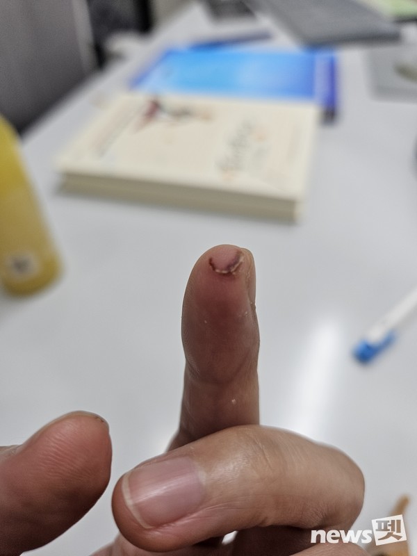 간식 소분 중 가위로 인해 부상입은 손. 사진 Audz